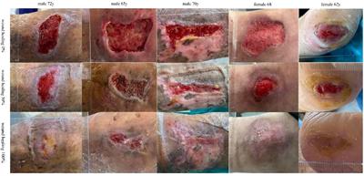 Sequencing of messenger RNA in the healing process of diabetes foot ulcer